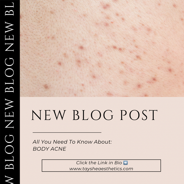 All About Body Acne: How To Get Rid Of Breakouts On Your Body!